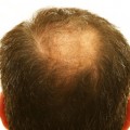 Balding head